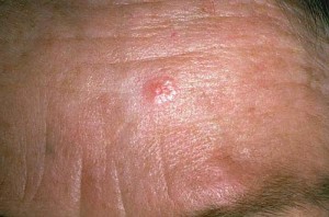 Kuva 5. Pahanlaatuinen basaliooma päänahassa. Huomaa vallimainen reunus. Myöhemmin keskiosaan kehittyy pientä verenvuotoa ja rupeutumista.