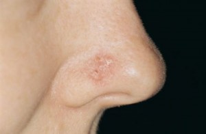 Kuva 7. Nenänpielen pahanlaatuinen basaliooma. Nenän alueen pahanlaatuisten ihokasvainten poisto vaatii kirurgista kokemusta.