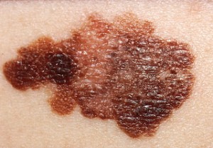 Kuva 11. Pahanlaatuinen melanooma. Huomaa epätarkkarajaisuus ja pigmentaatiotasojen erot. 