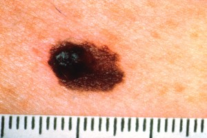 Kuva 12. Pahanlaatuinen melanooma. Huomaa hyvin tumma kohta ja epätarkkarajaisuus. Muutos kannattaa heti poistaa selvällä tervekdosmarginaalilla. 