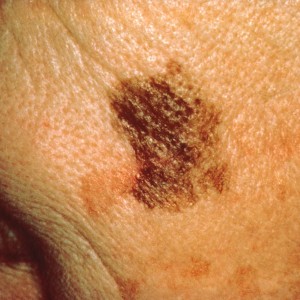 Kuva 13. Pahanlaatuinen melanooma. Pinnallisesti etenevä kasvu on johtanut melko laaja-alaiseen muutokseen, jonka poisto vaatii kirurgista kokemusta. 